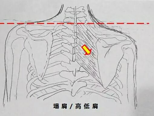 《恼人的"肩胛内侧痛"!